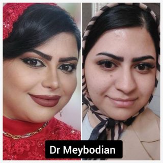 جراحی بینی گوشتی